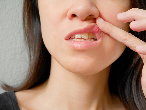 Canker Sore - Cause of Sore Tongue that Hurts Tip