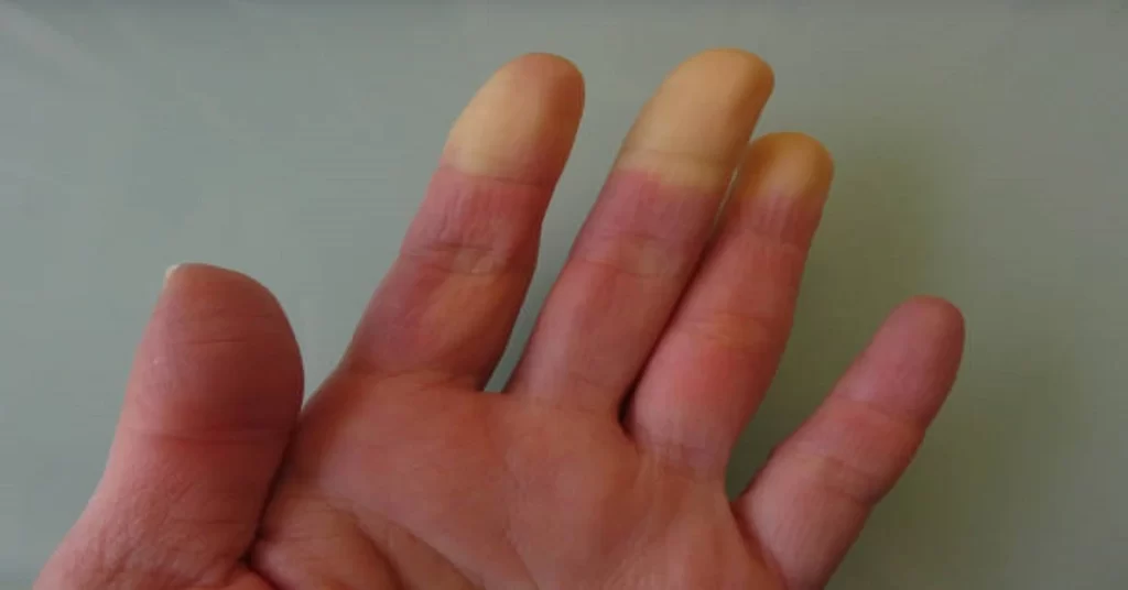 Raynaud's Illness - Causes of Fingertips Numbness